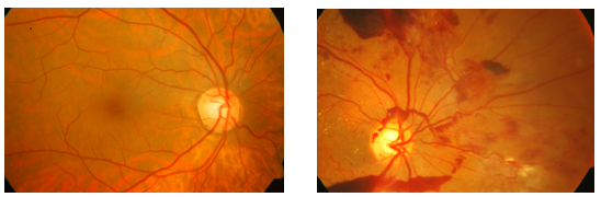 Diabetic Eye Disease - Icare